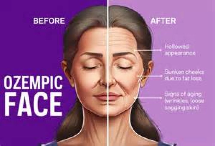 Celebrities Taking Ozempic: The Trend, Benefits, and Potential Risks